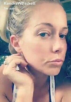 kendra wilkinson botox snapchat
