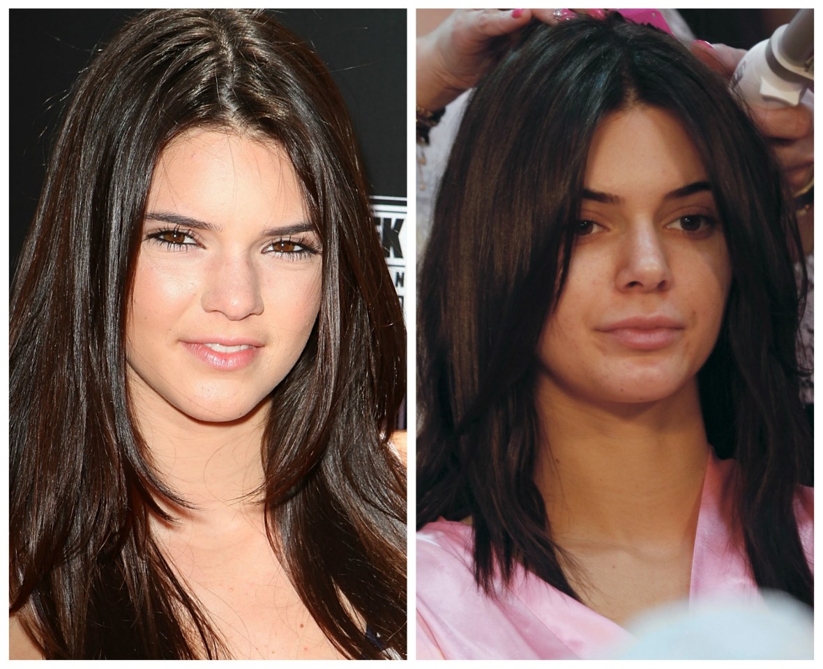 Did Kendall Jenner Get Plastic Surgery New Victorias