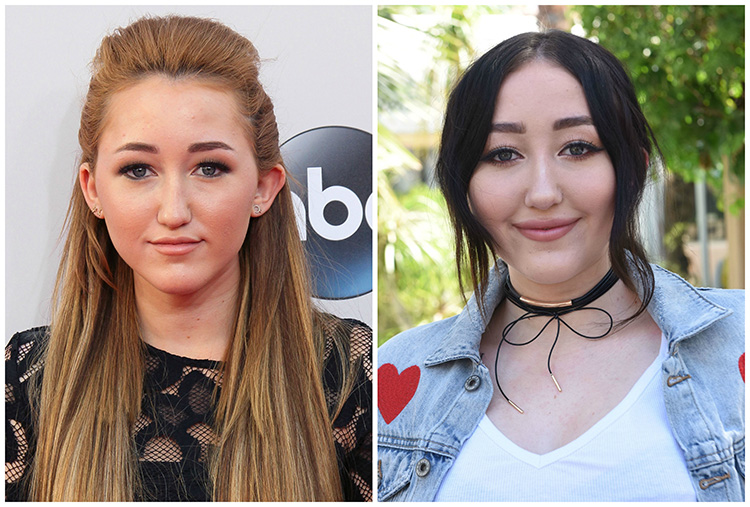Plump Lips Without Surgery 2013 - Did Noah Cyrus Get Plastic Surgery?! Experts Weigh in on Her ...
