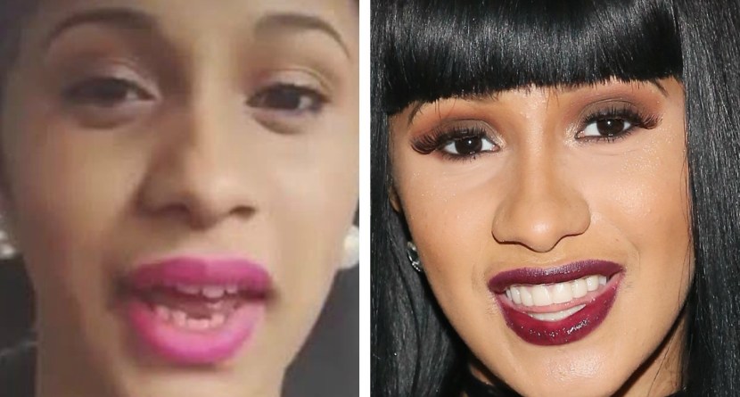 Did Cardi B Get Her Teeth Fixed See Before And After Pictures 