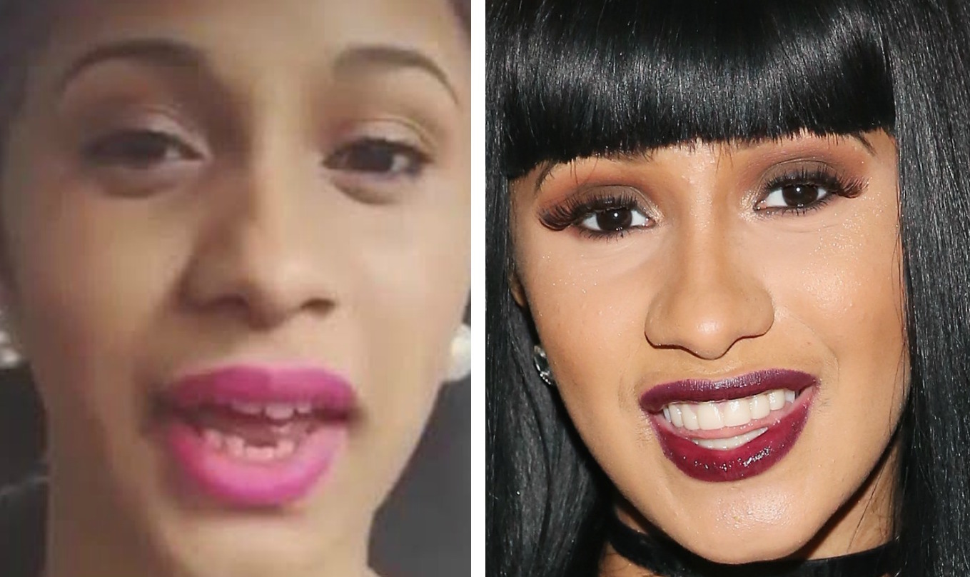 Rapper Cardi B Didn’t Always Have That Smile — See Before-and-After ...