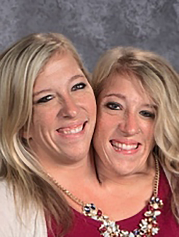 Conjoined twins Abby and Brittany Hensel: Where are they today? 