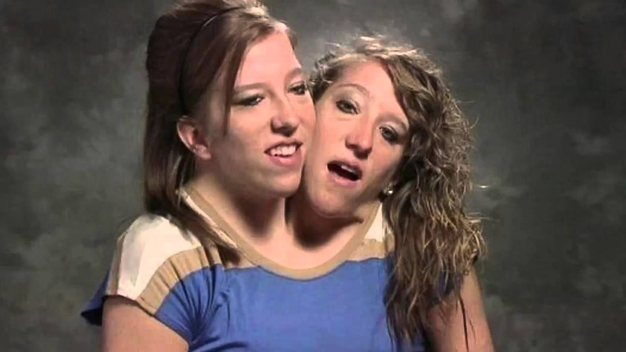 Conjoined twins now teach fifth grade