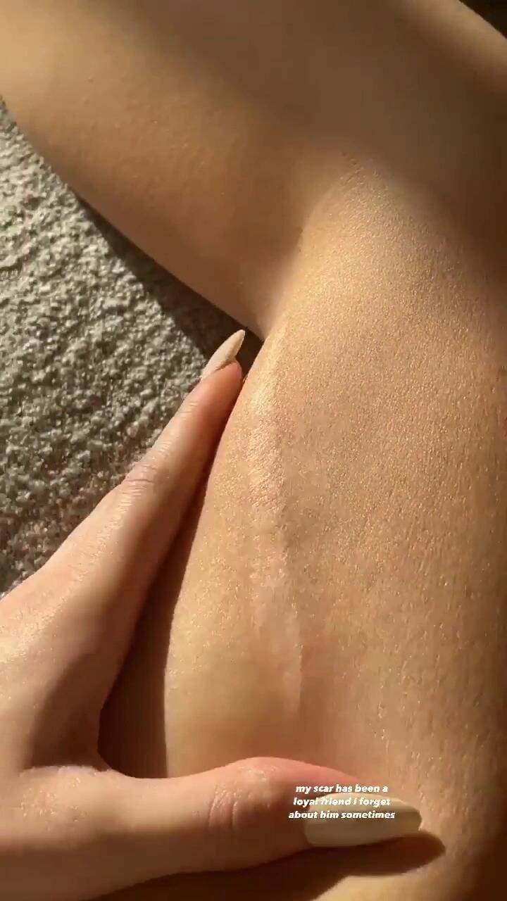 Kylie Jenner Leg Scar
