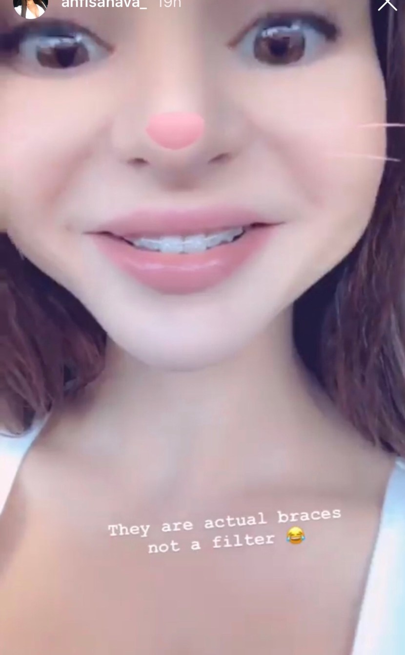 Anfisa Arkhipchenkos Braces 90 Day Fiancé Star Shows Off Her New Look 