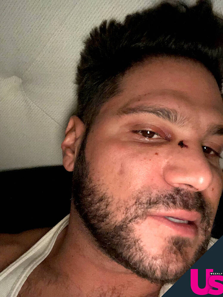 Ronnie Ortiz-Magro Says Jen Harley Allegedly Threw An Ash Tray At His Face Leaving Him Bloody And Bruised